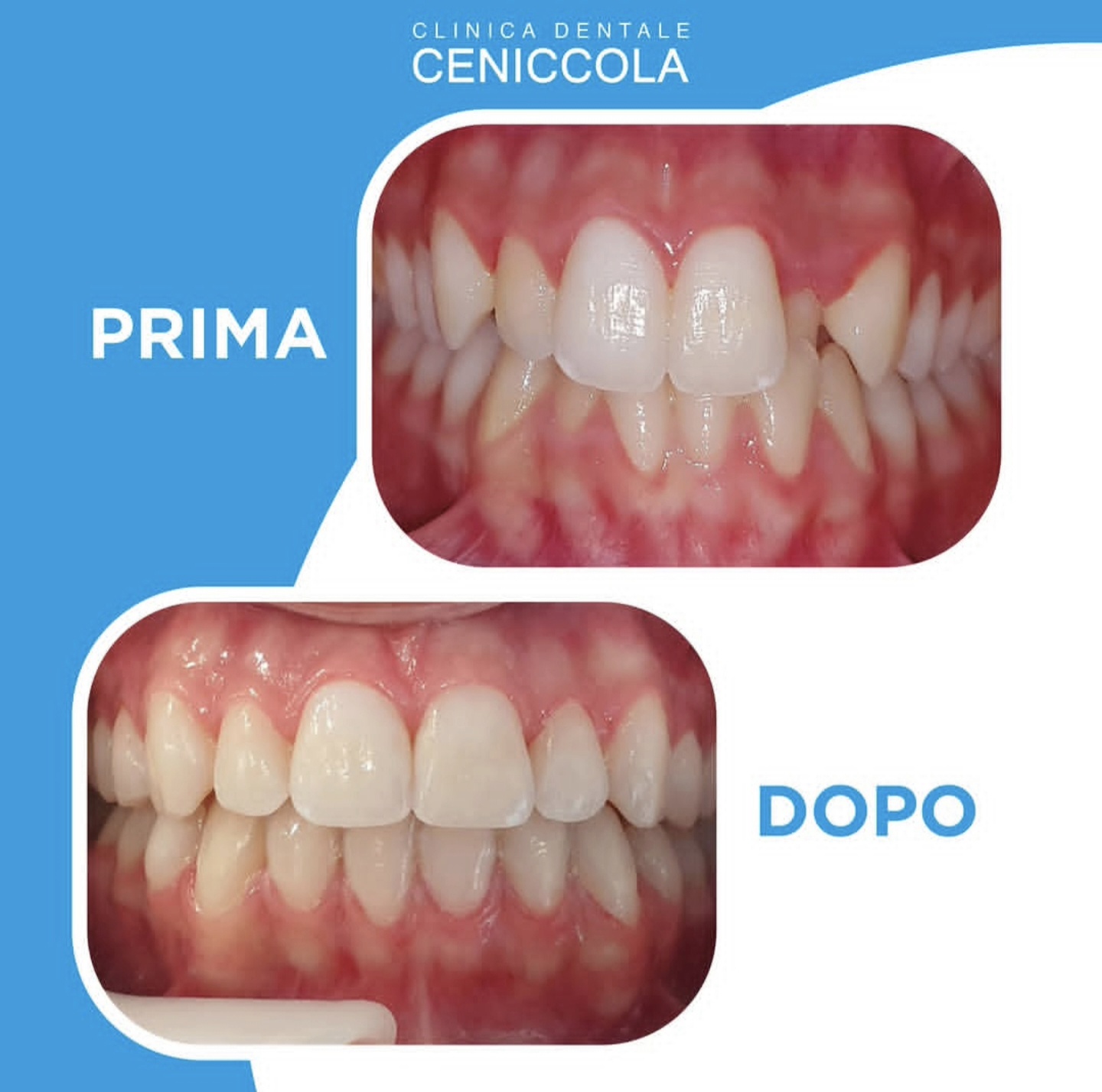 Caso clinico prima/dopo